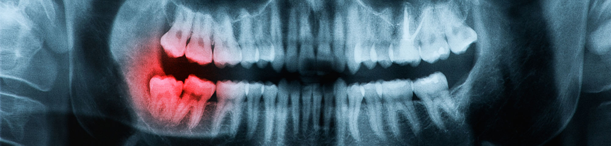 x-ray of impacted wisdom teeth