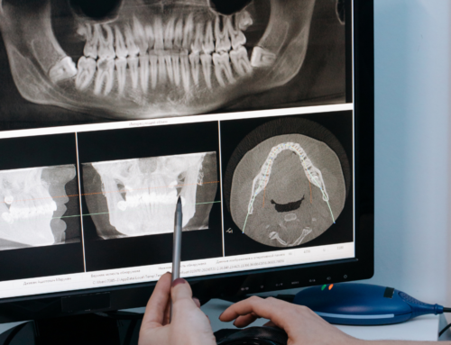 Exploring the World of Bone Grafting for Dental Health