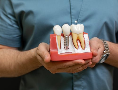 Guide to Dental Implants in Fairbanks for Long-Term Tooth Replacement