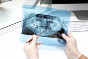 dental bone grafting