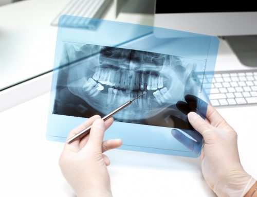Dental Bone Grafting Surgery: Timeline, Recovery, Risks, and Prep